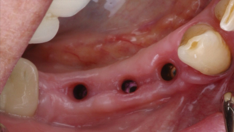 Patient's failing teeth were removed in the lower left posterior quadrant