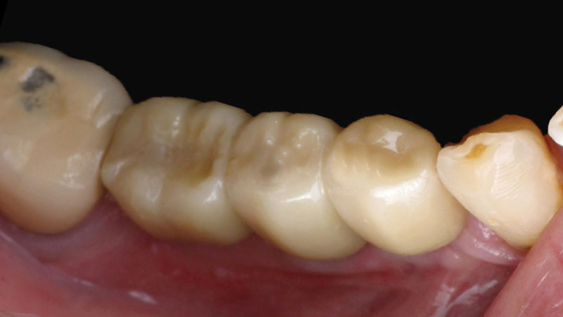 Three BruxZir Full-Strength Zirconia screw-retained crowns were created, connected to the Hahn implants and evaluated for final adjustments