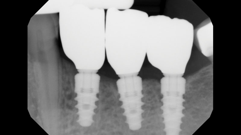 Final radiograph shows the integrated Hahn Tapered Implants as well as the individual BruxZir crowns after delivery