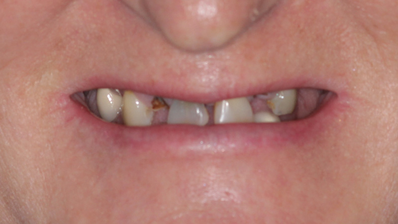 Extraoral image of the patient with terminal dentition and poor esthetics and function