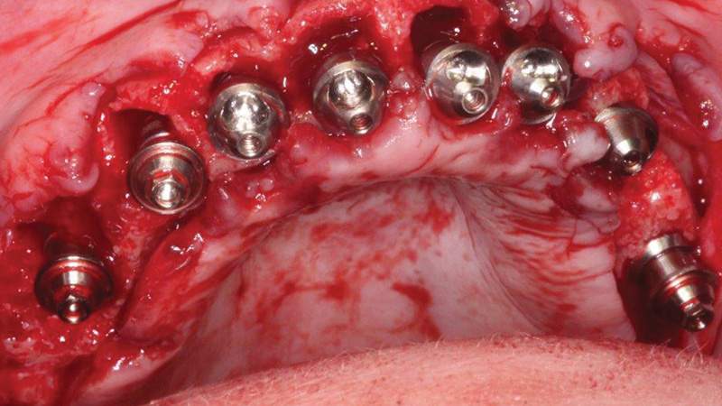  Maxillary teeth were extracted and alveoplasty was performed and osteotomies were created for the Hahn Tapered Implants